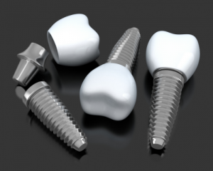 'dental implants'