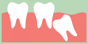 wisdom tooth