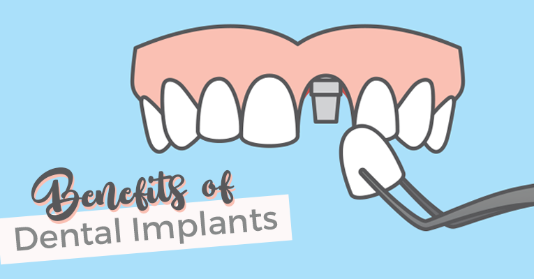 Benefits of Dental Implants graphic