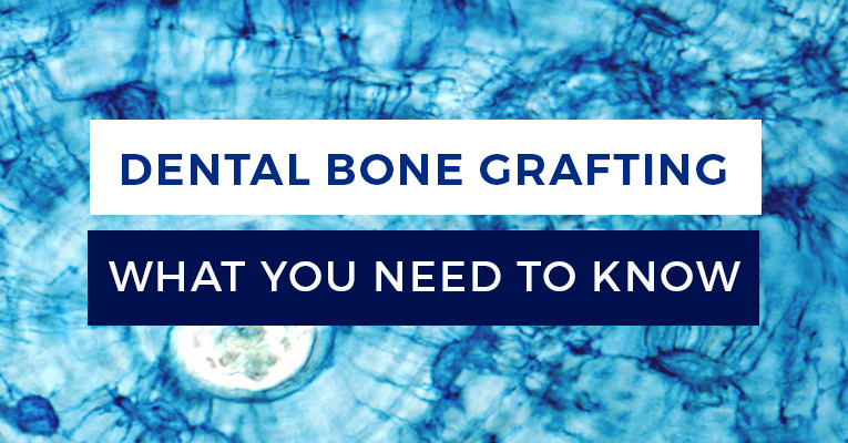 Everything you need to know about Dental Bone Grafting